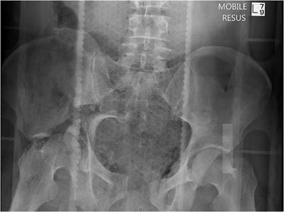 The Road to Survival for Haemodynamically Unstable Patients With Open Pelvic Fractures